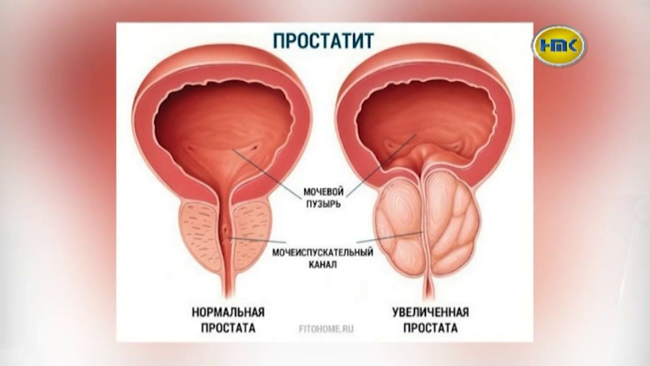 Массаж простаты, репродуктивный массаж