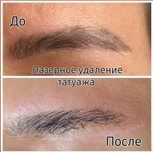 Удаление татуажа и татуировок