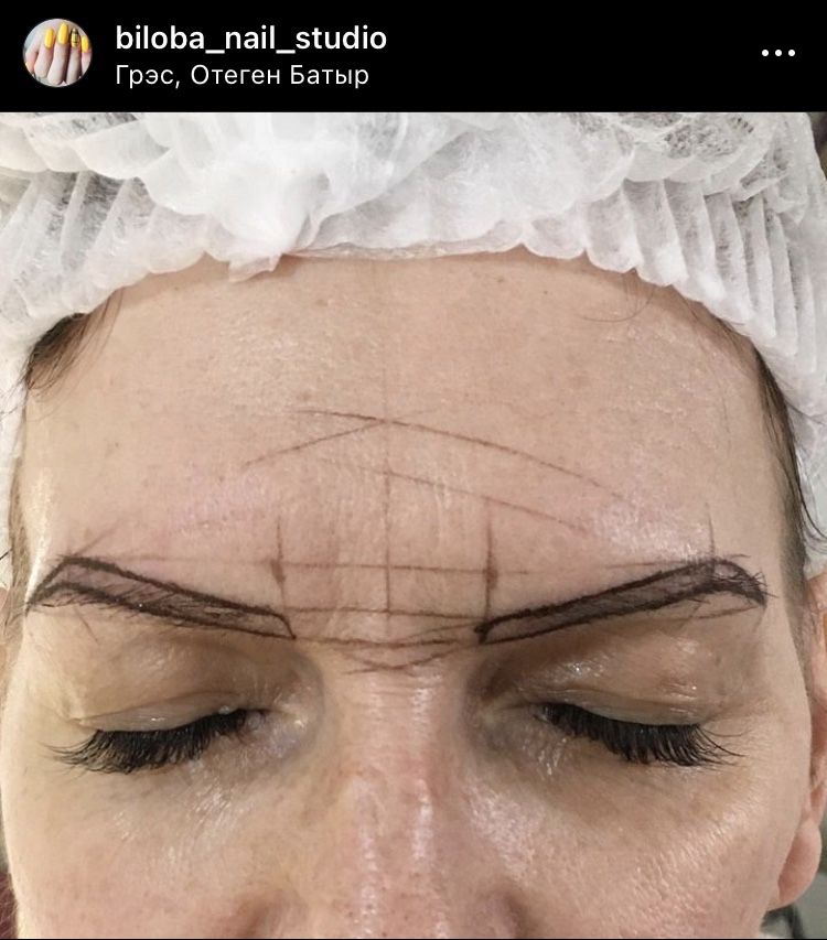 Татуаж бровей, удаление татуажа