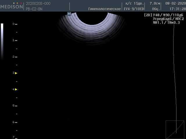 УЗИ сканер SonoAce-X6 (Samsung Medison) с 3 датчиками