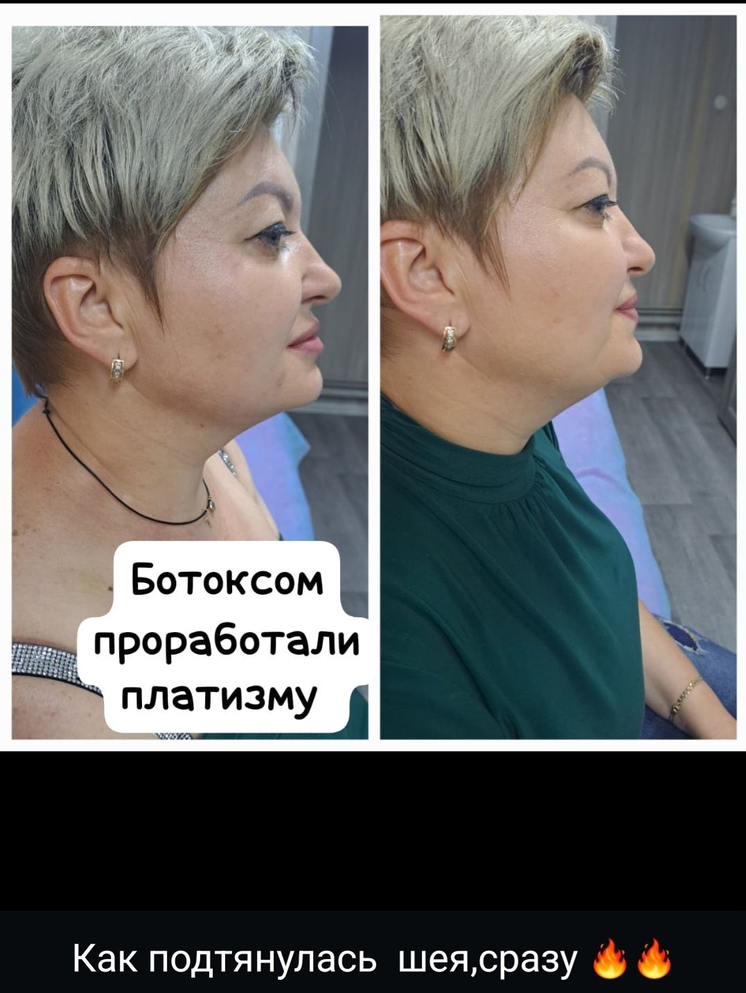 Косметолог  Акция увеличение губ 1 мл 30000тг 
1 мл- 43000тг+  чистка