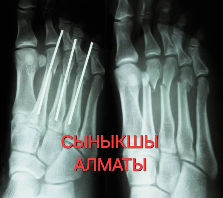 Сыныкшы Костоправ Алматы