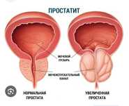 Простатитке массаж жасап Сүлікпен емдеймін