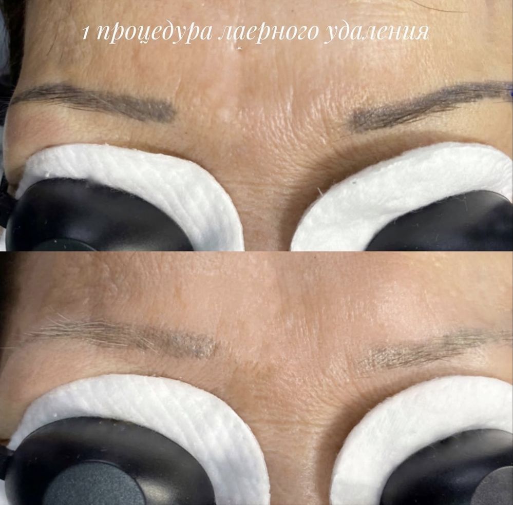 Удаление тату и татуажа