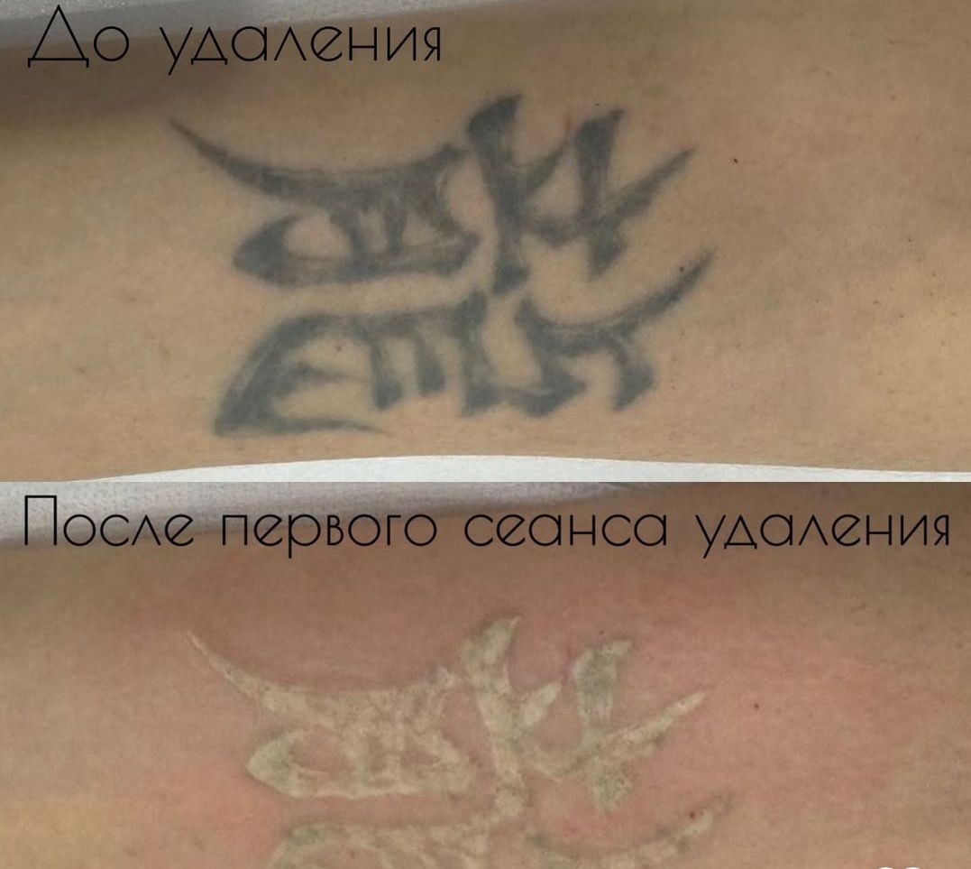 Лазерный удаление татуаж татуировки