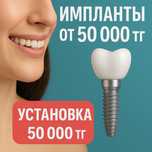 Импланты Астана. Импланты от 50.000